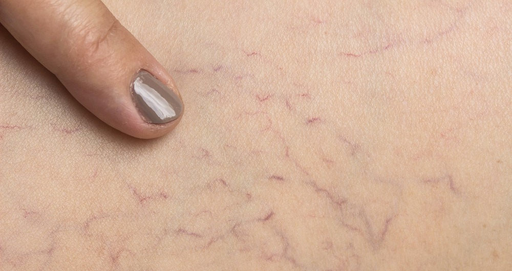 Why You Should Not Ignore Spider Veins